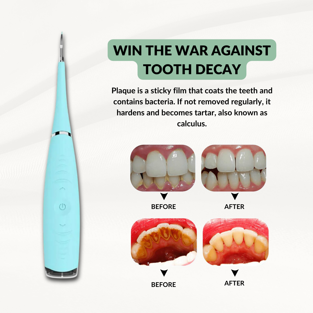 SmileSonic™- At-Home Ultrasonic Tooth Cleaner